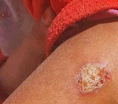 تجاوز 30 إصابة بالليشمانيا في بني وليد منذ منتصف نوفمبر.