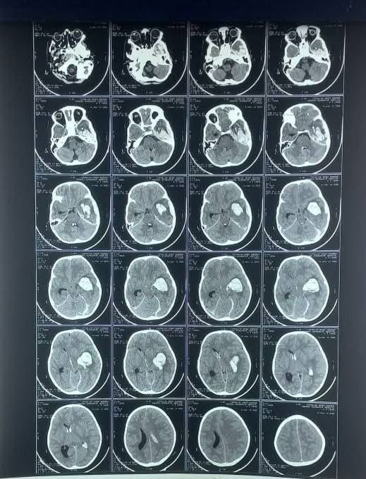   نجاح جراحة عاجلة لطفل مصاب بالهيموفيليا في مركز بنغازي الطبي